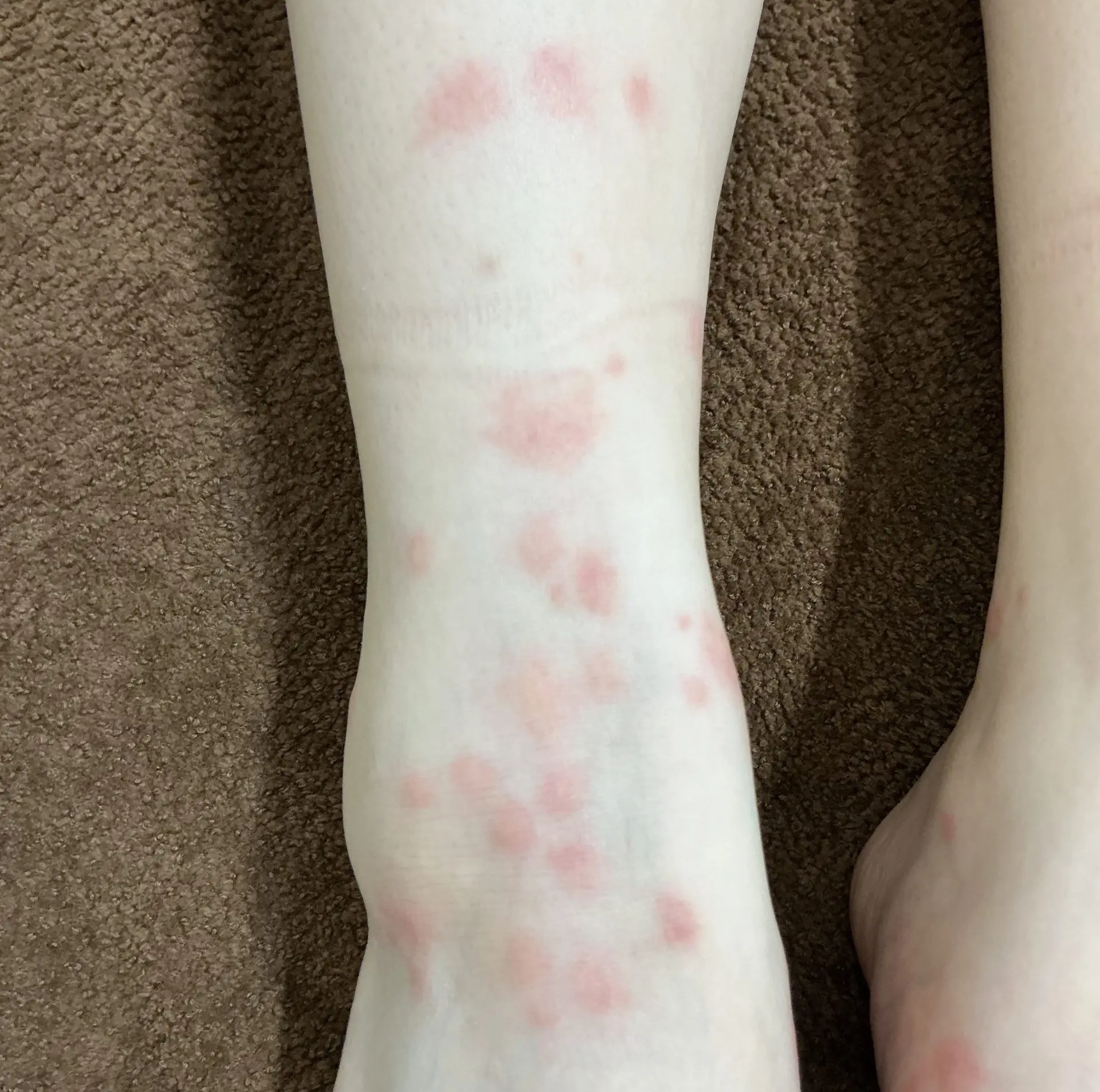 虫刺されの酷い腫れと熱感の真相｜原因別の見分け方と皮膚科受診の目安