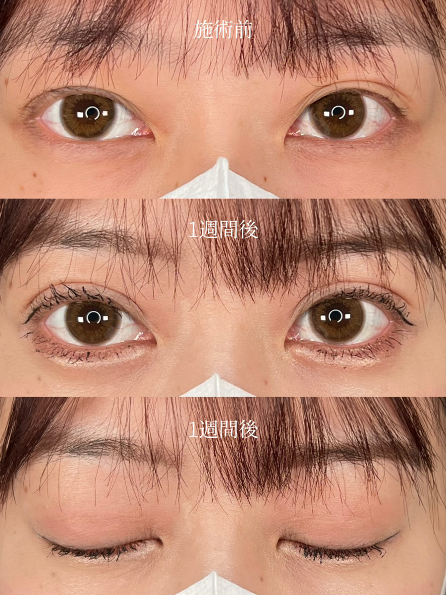 蒙古襞があっても理想の二重は作れる？2026年最新手法と失敗回避術