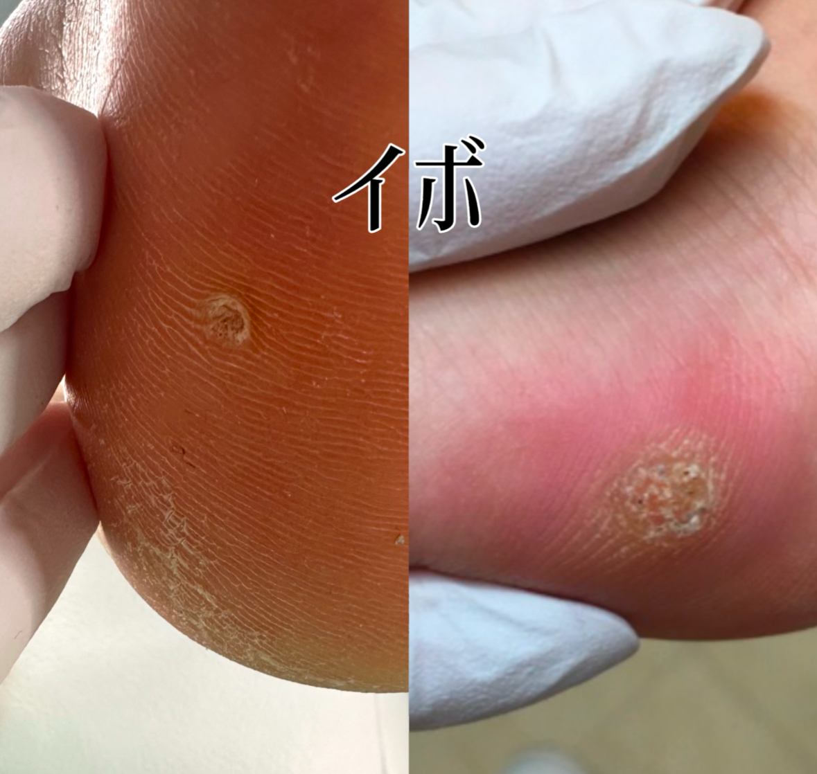 足裏のしこりは魚の目かイボか？見分け方の決定打と危険な自己処理