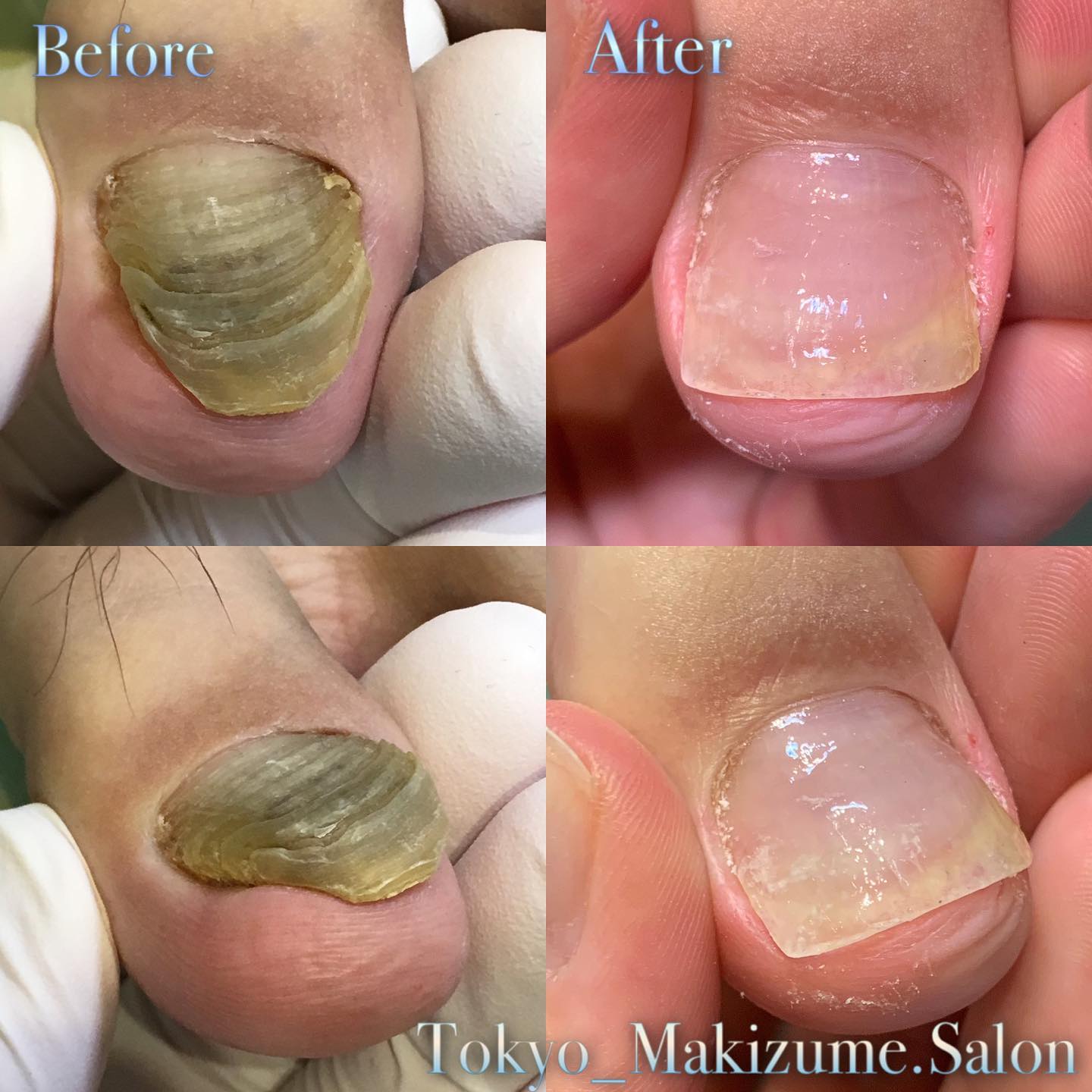 足の爪が分厚く濁る爪甲鉤彎症の治し方と原因！皮膚科治療と自宅ケア解説