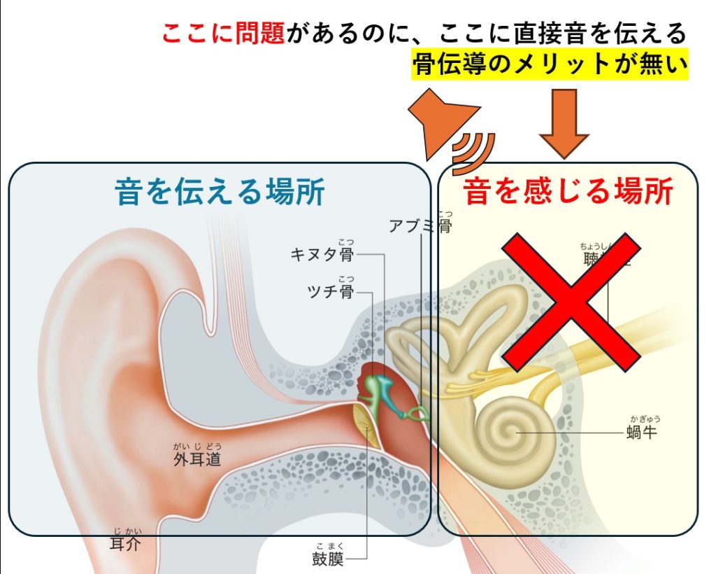 骨伝導補聴器の真実！後悔する理由と集音器との違いを徹底解剖