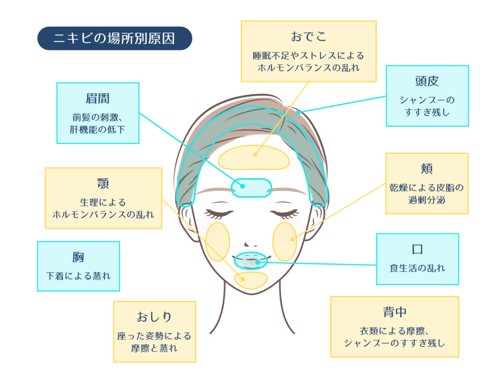 繰り返すニキビを本気で治す方法｜皮膚科の最新治療と正しいケア徹底解説