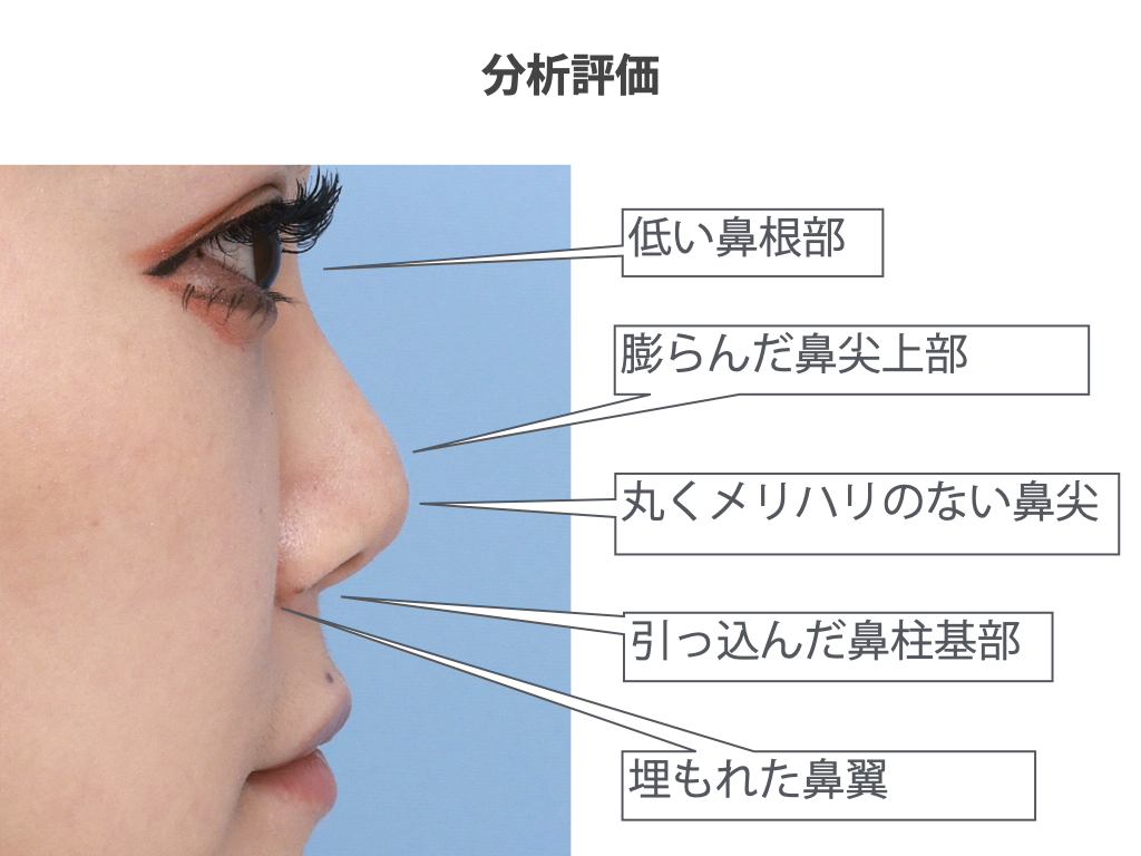 鼻が低いは武器になる？骨格の真相と整形なしで劇的垢抜けを叶える全技術