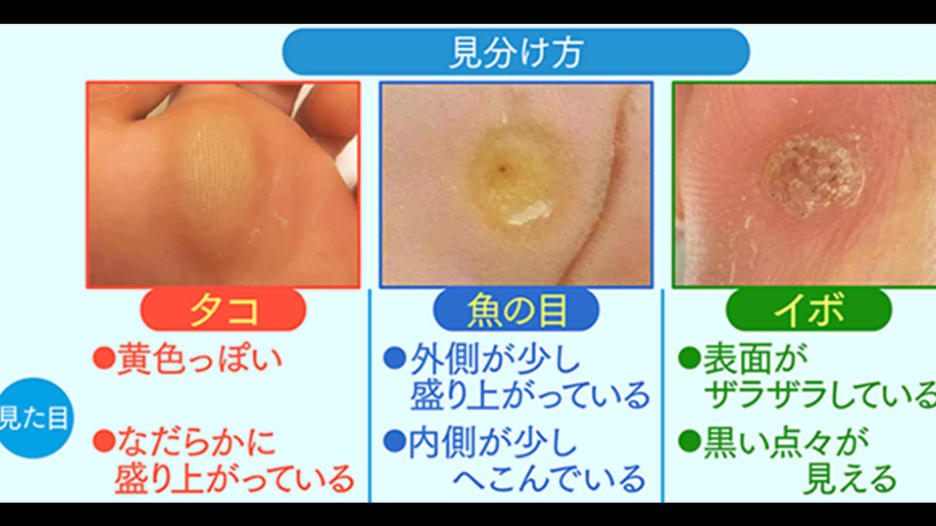 魚の目とタコの違いとは？芯の有無で見分ける痛みの原因と治し方
