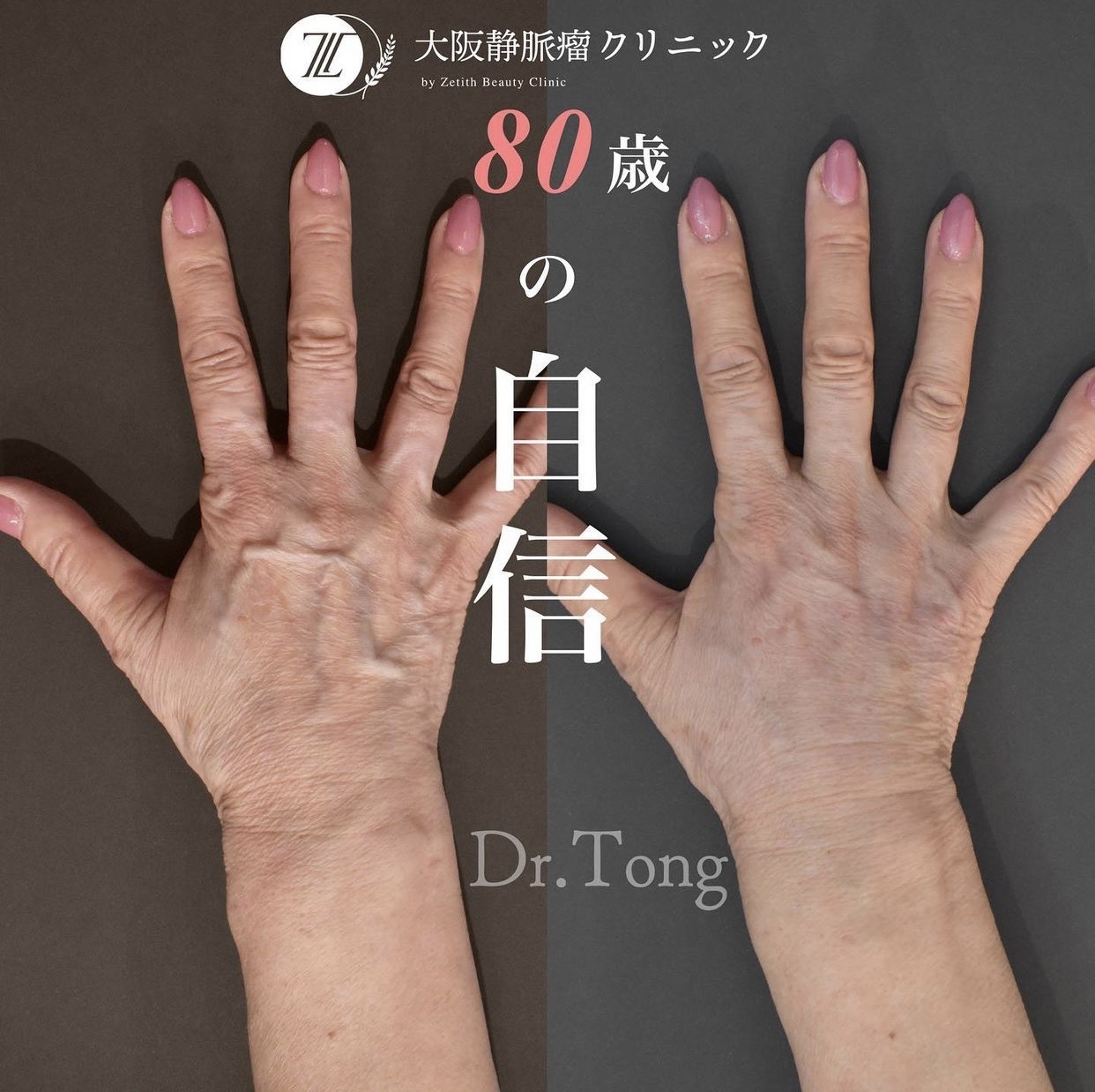 手の血管が浮き出る原因と治し方｜病気のサインと改善法を徹底解説