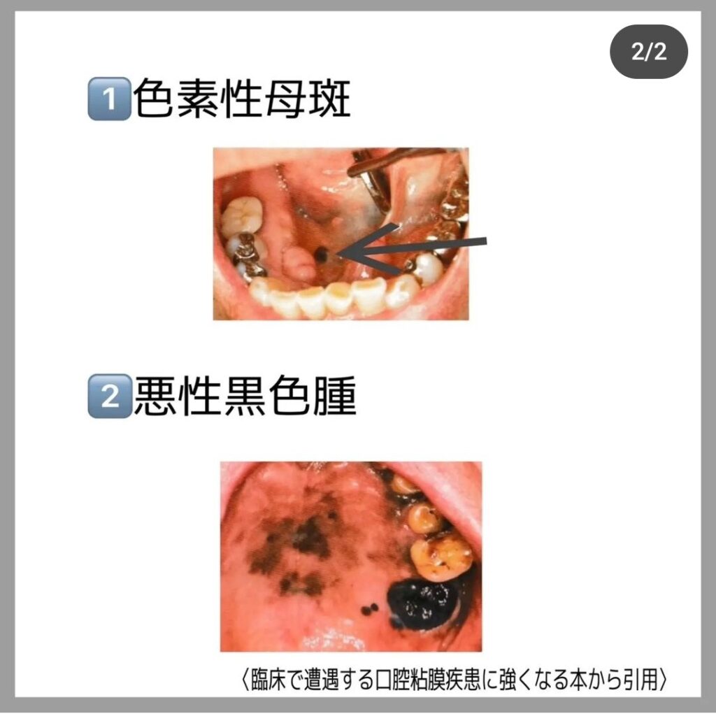 口の中にほくろ？黒い点の正体と危険な兆候を見分ける基準【2026年最新】