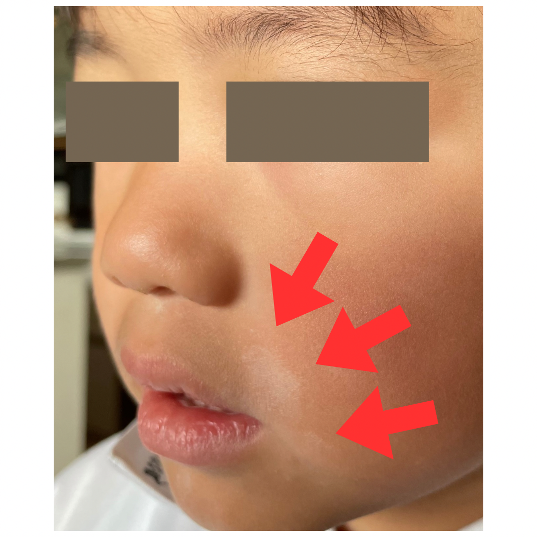 顔の白い斑点は病気の前兆？皮膚科医が明かす原因と最新治療の全貌