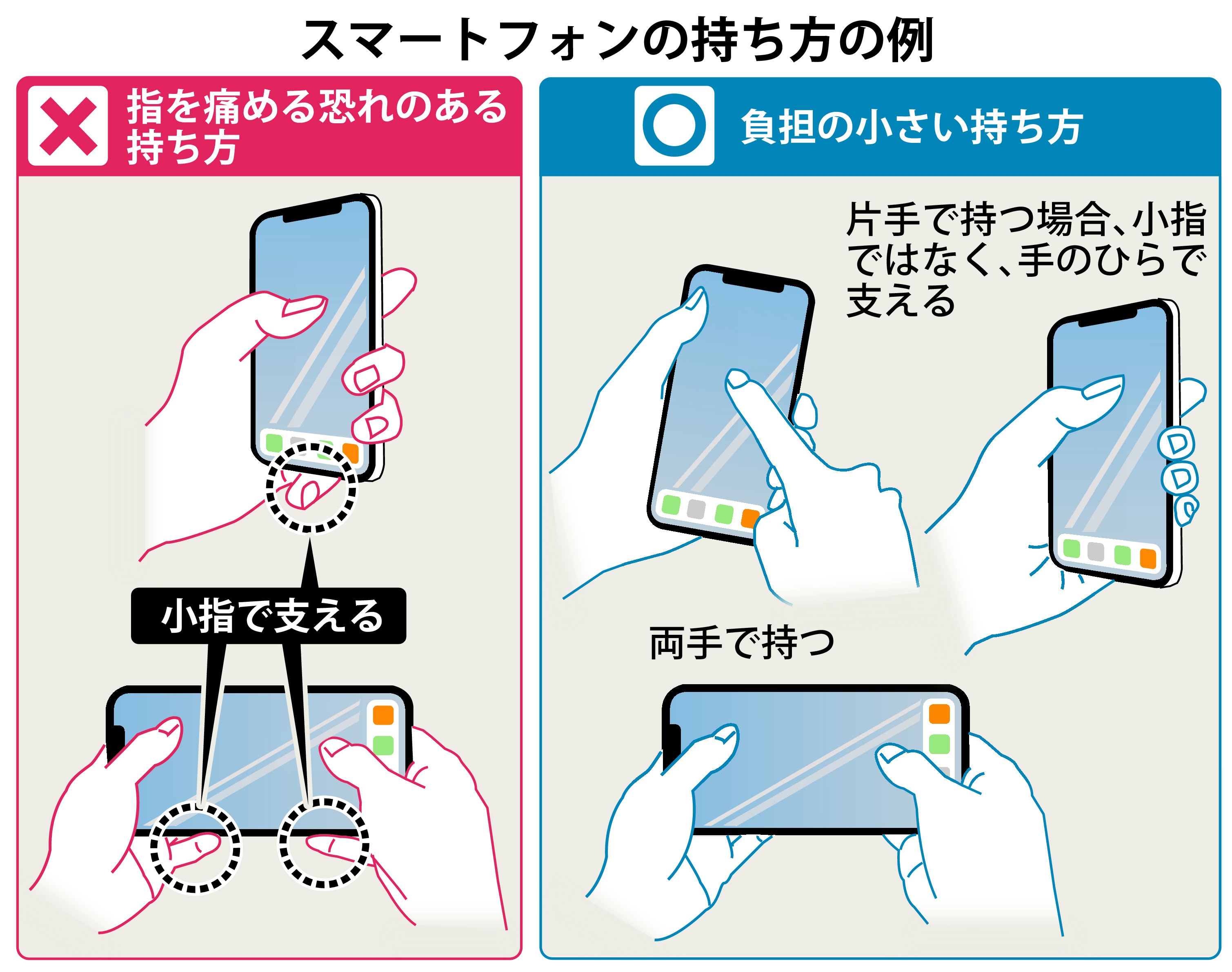 スマホで小指が変形する噂の真相とは？凹みは戻るのか医師が徹底解説