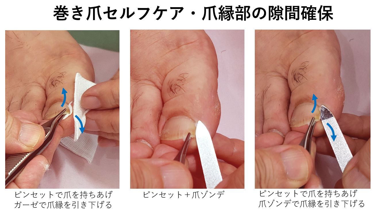 痛い巻き爪を自分で治す方法！Ng行為と正しいセルフケア徹底解説
