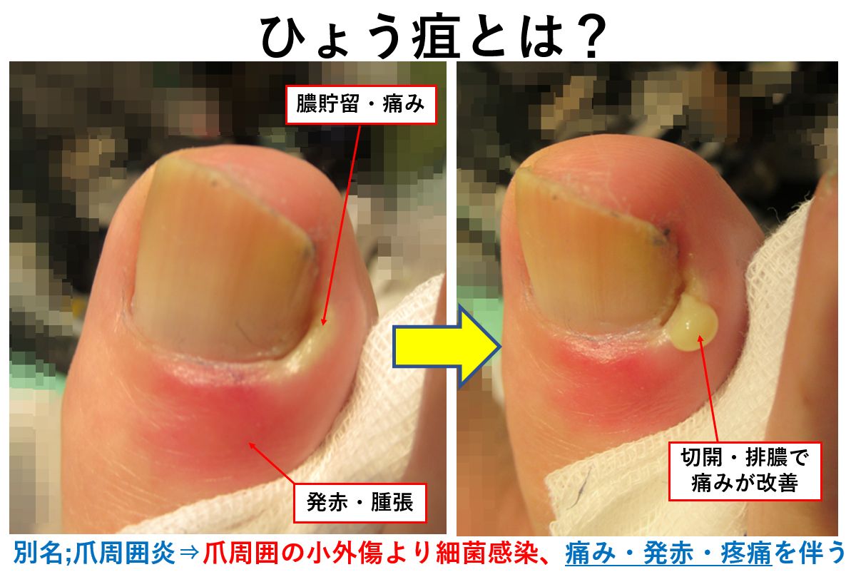 爪周囲炎の治し方と原因｜指先の激痛・膿の対処法と市販薬の真実