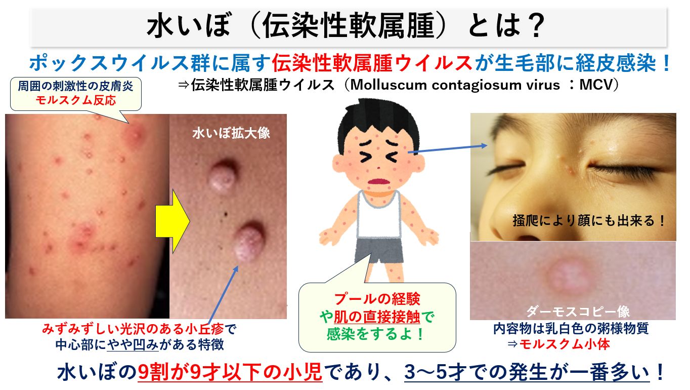 水いぼは取るべき？放置か自然治癒か、痛くない最新治療と登園基準