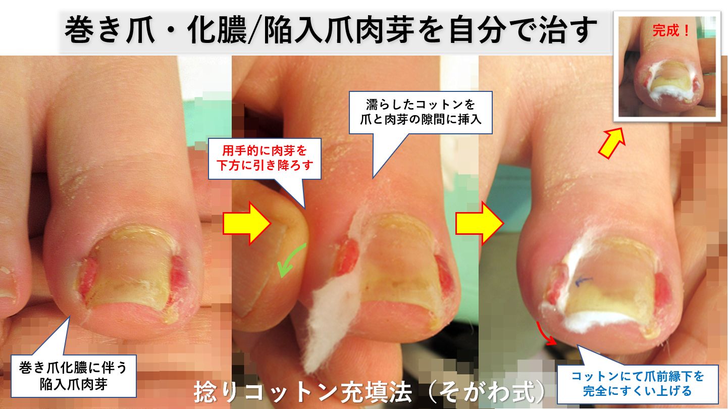 爪周囲炎は自分で治せる？腫れと膿への市販薬選びと危険なNg処置