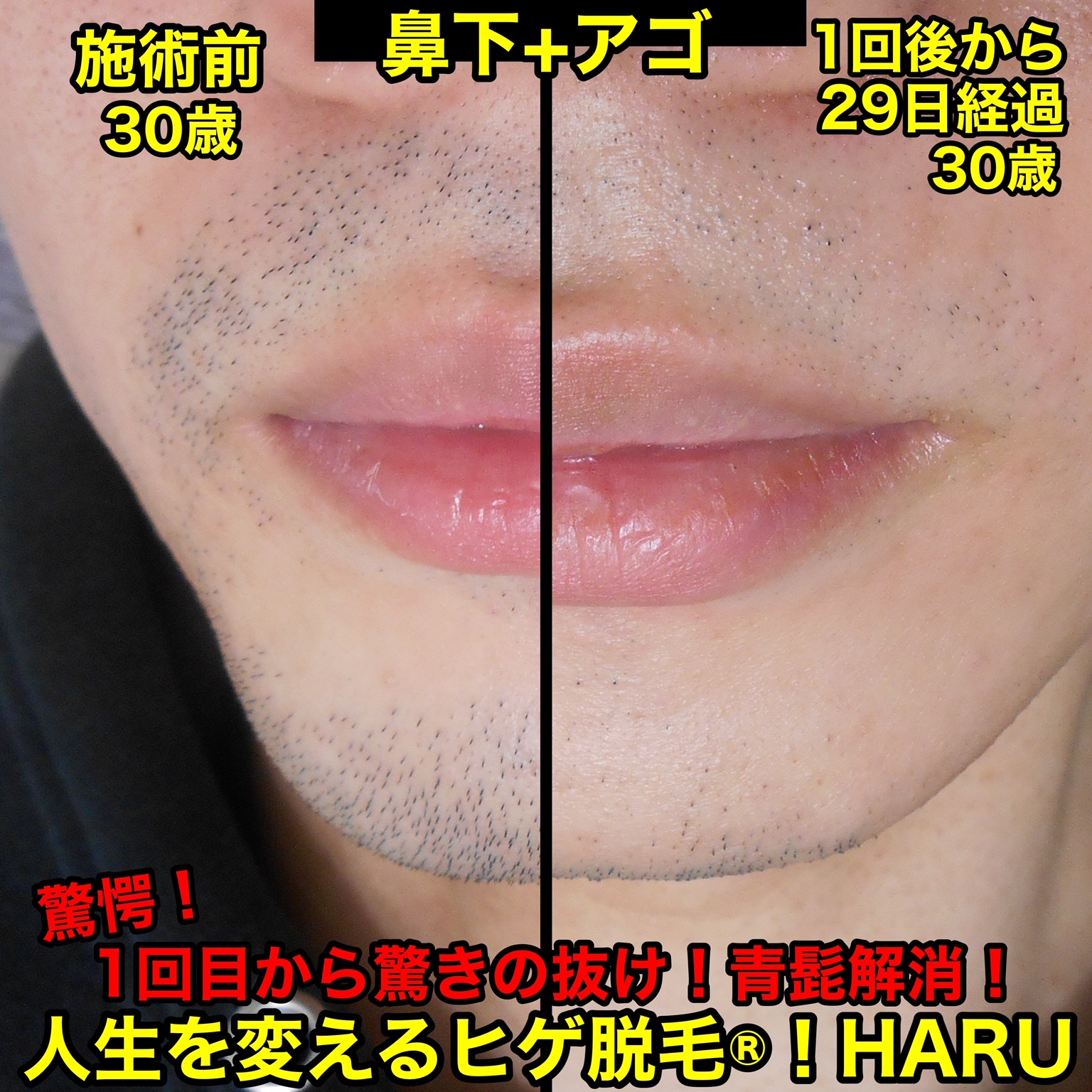 鼻の下の髭が濃い原因と対策｜青髭・女性の産毛ケアから脱毛まで