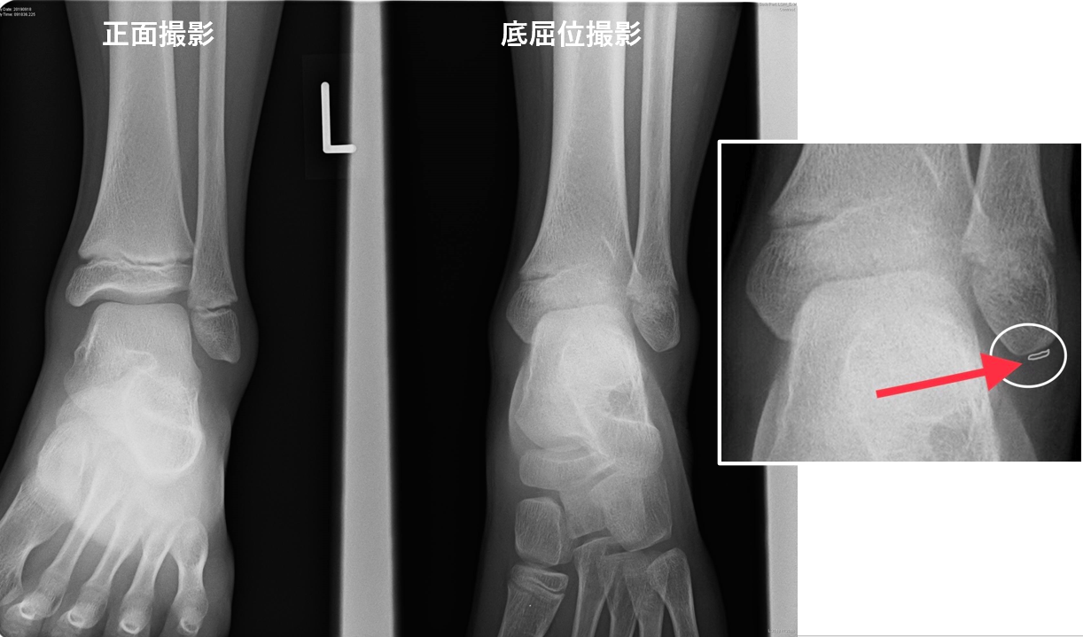 足首の捻挫と骨折を見分ける方法｜歩けるのに折れている危険なサイン