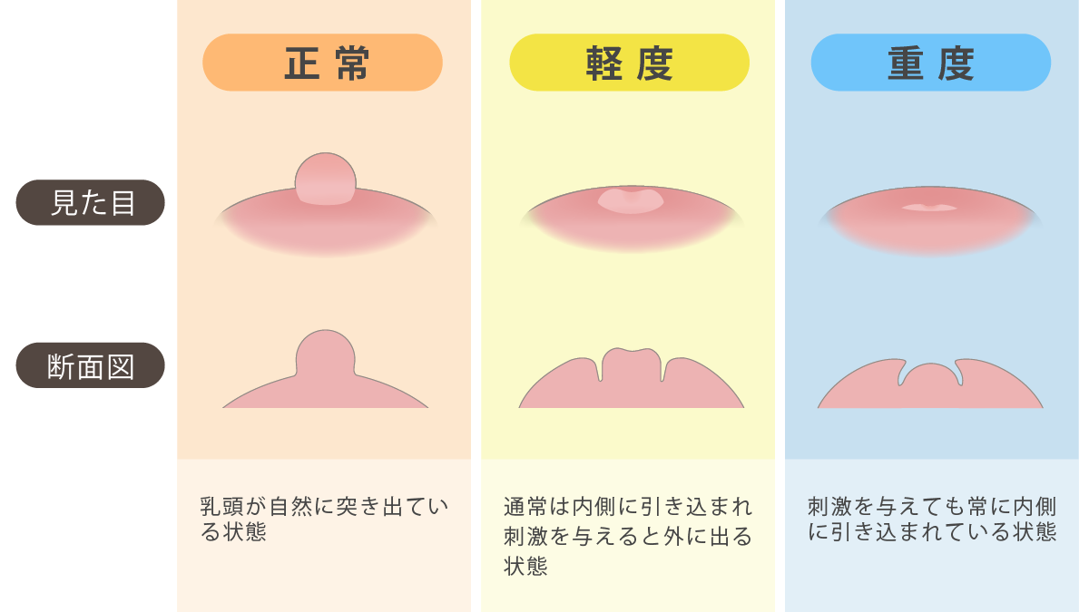 陥没乳頭の原因とは？先天性と病気のリスクや治し方を徹底解説