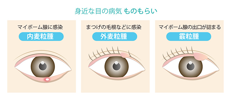 まぶたのふちに白いできもの？痛くない原因の正体と今すぐできる治し方
