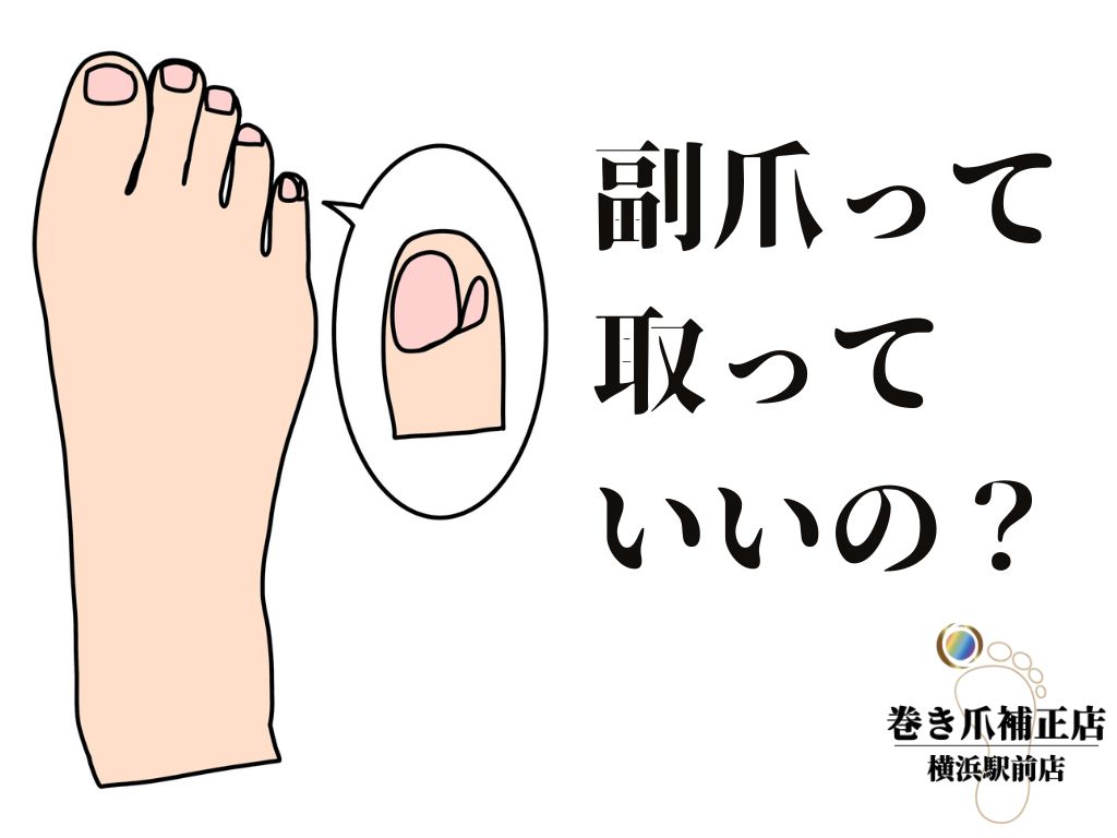 足の小指の副爪を引っこ抜くのは危険？原因と正しい治し方を徹底解説