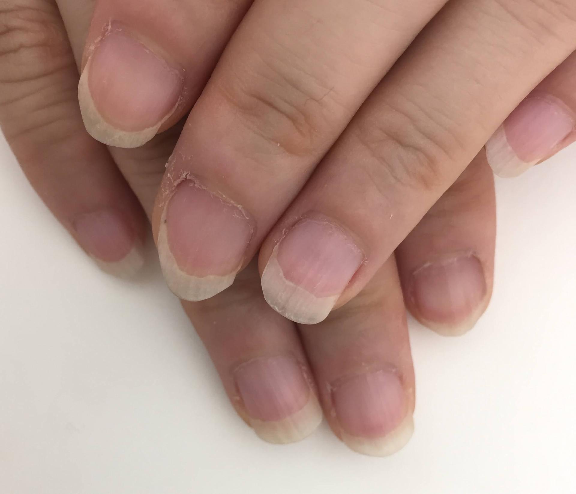 爪の白い部分が多いのはなぜ？隠れた病気のサインと美爪育成の新常識