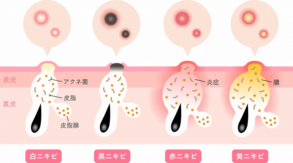 ニキビの白い膿は潰す？放置？跡を残さない2026年最新の治し方