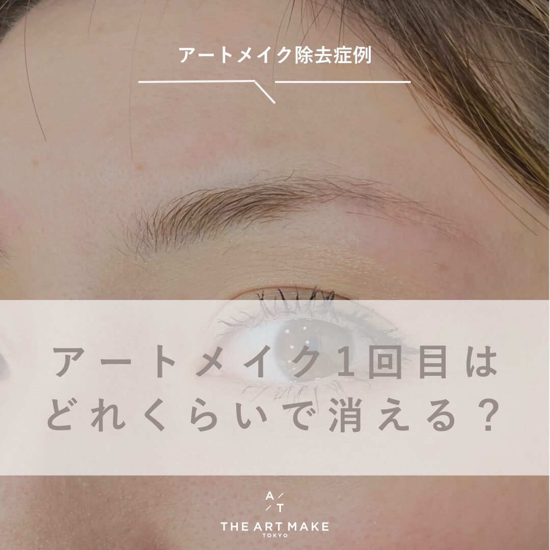 アートメイクは本当に消える？すぐ薄くなる原因と最新除去法を徹底解説