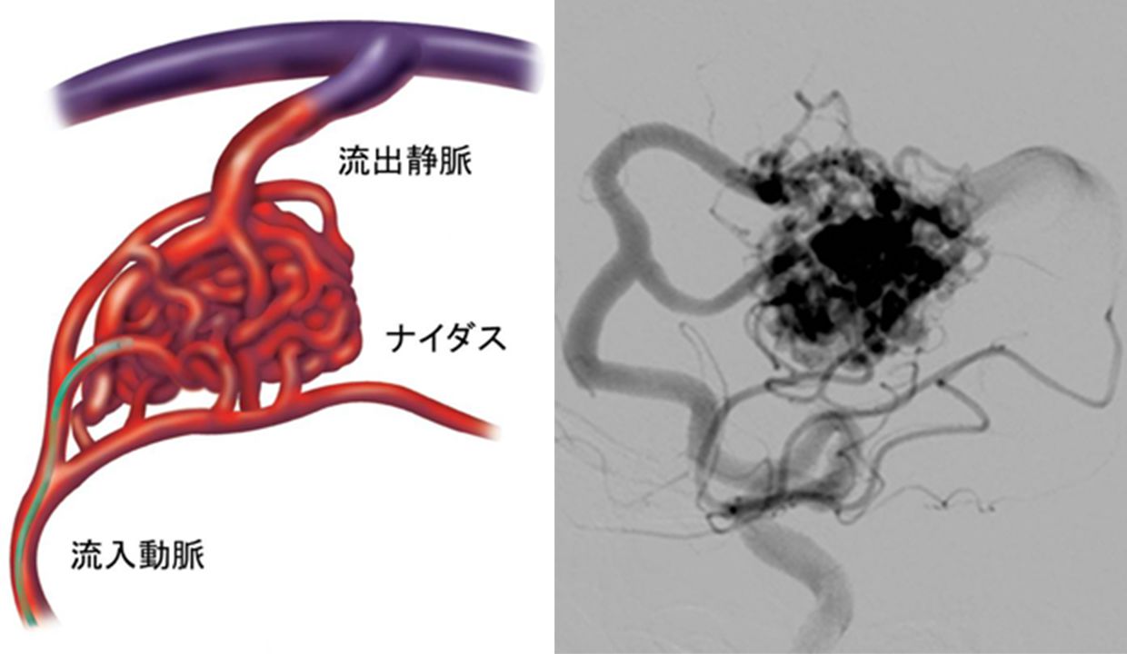 脳動静脈奇形の余命と生存率｜破裂確率と完治へ導く最新治療の現実