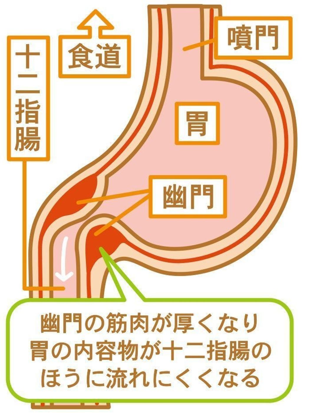 赤ちゃんの噴水状嘔吐はなぜ？肥厚性幽門狭窄症のサインと手術・入院全知識