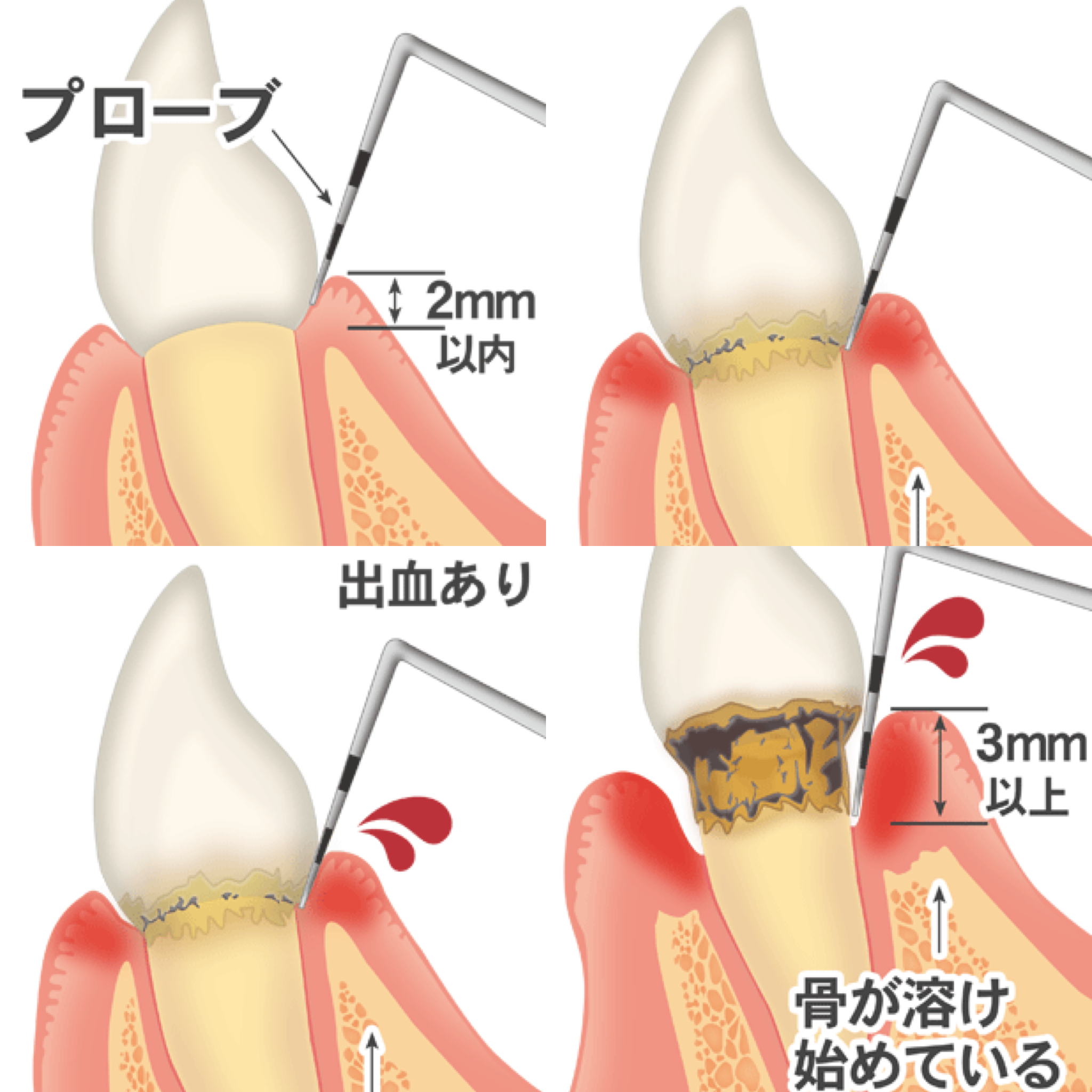 歯周病検査が痛い本当の理由｜数値の危険度と保険適用を完全解説