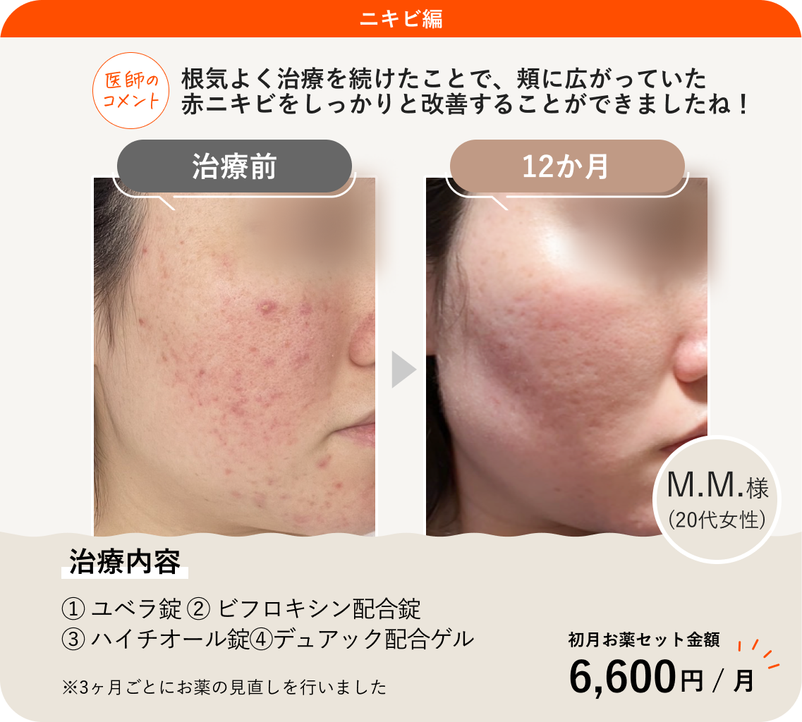 赤ニキビの治し方を徹底解説！痛い炎症を一刻も早く鎮静する全手順