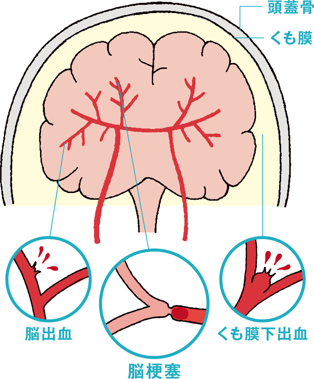 無症状で進む隠れ脳梗塞の正体と兆候｜認知症を防ぐ最新予防策を徹底解説