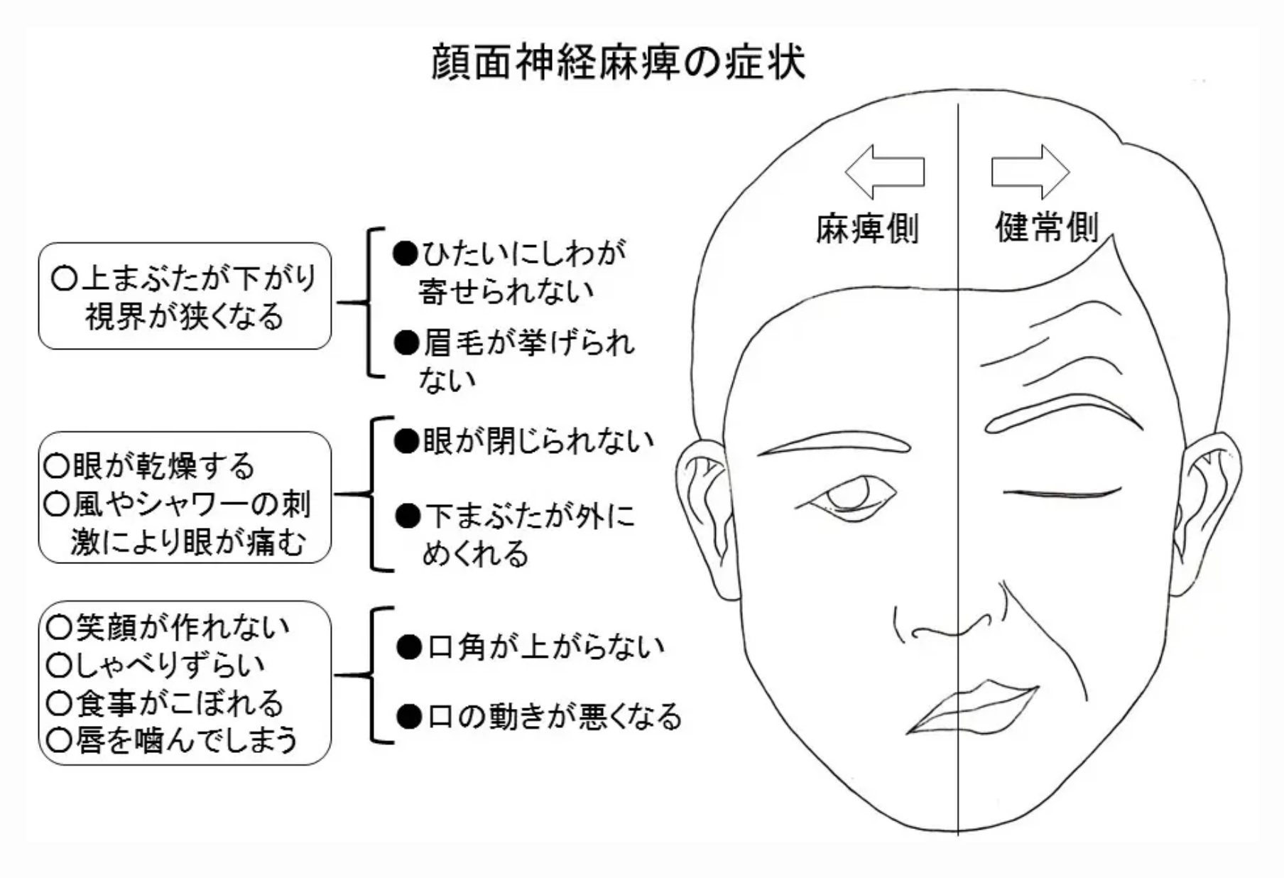 ラムゼイハント症候群の初期症状と原因！治る確率と後遺症を防ぐ治療法