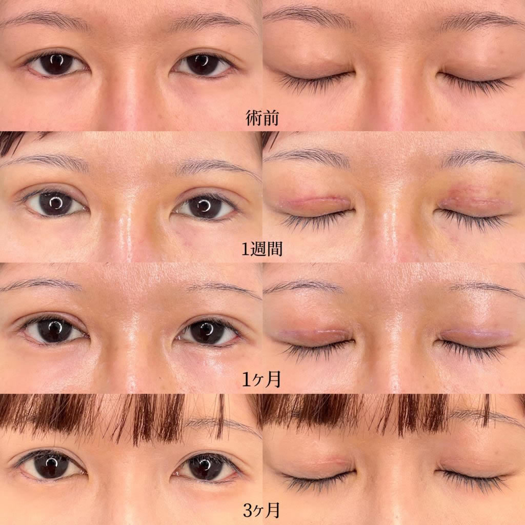 眼瞼下垂の手術後ダウンタイム完全解説！腫れピークと仕事復帰の目安