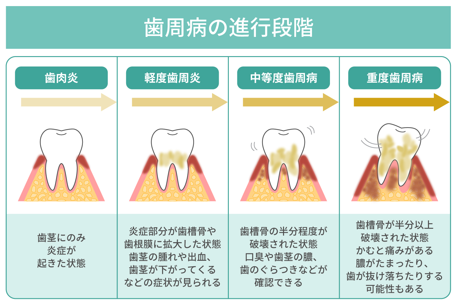 歯周病の手遅れ症状とは？抜歯宣告を回避する限界ラインと最新治療