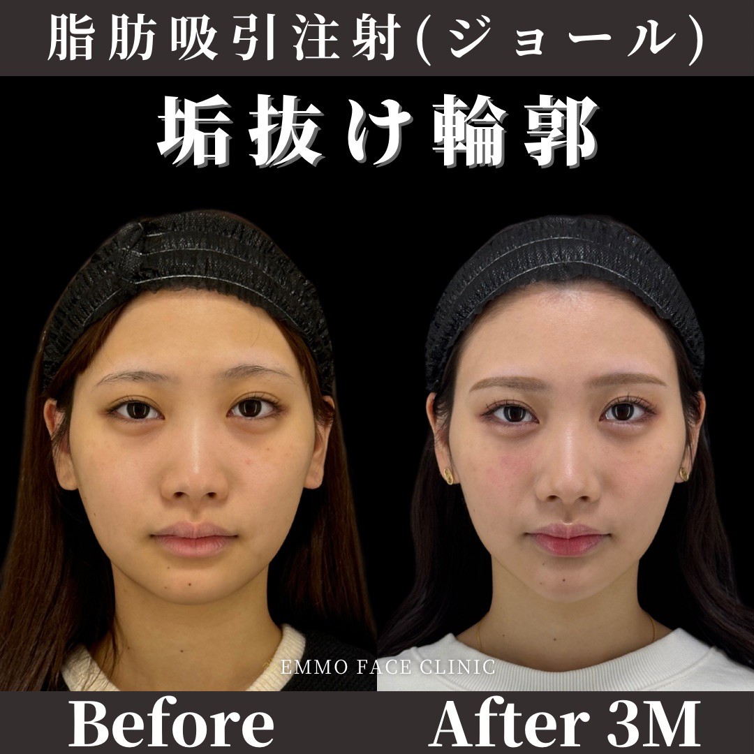 頬の肉を落とす最短術！落ちない理由と2026年最新の即効顔痩せ法