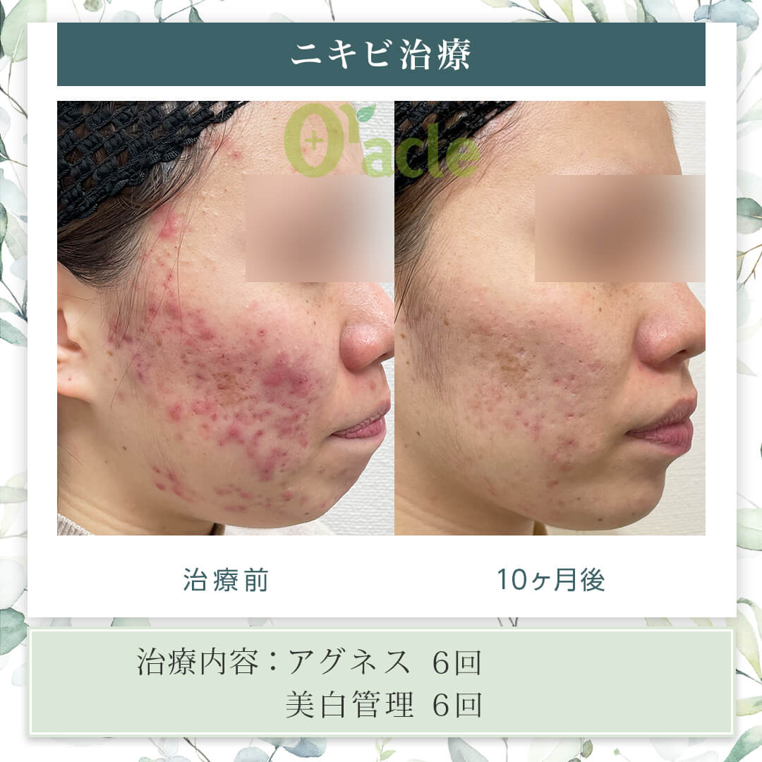 皮膚科のニキビ治療は市販薬と何が違う？処方薬の効果と費用を徹底検証