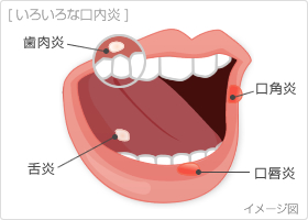 【経歴】 口内炎 の 治し 方 裏 ワザ ファン必見の最新情報 #961