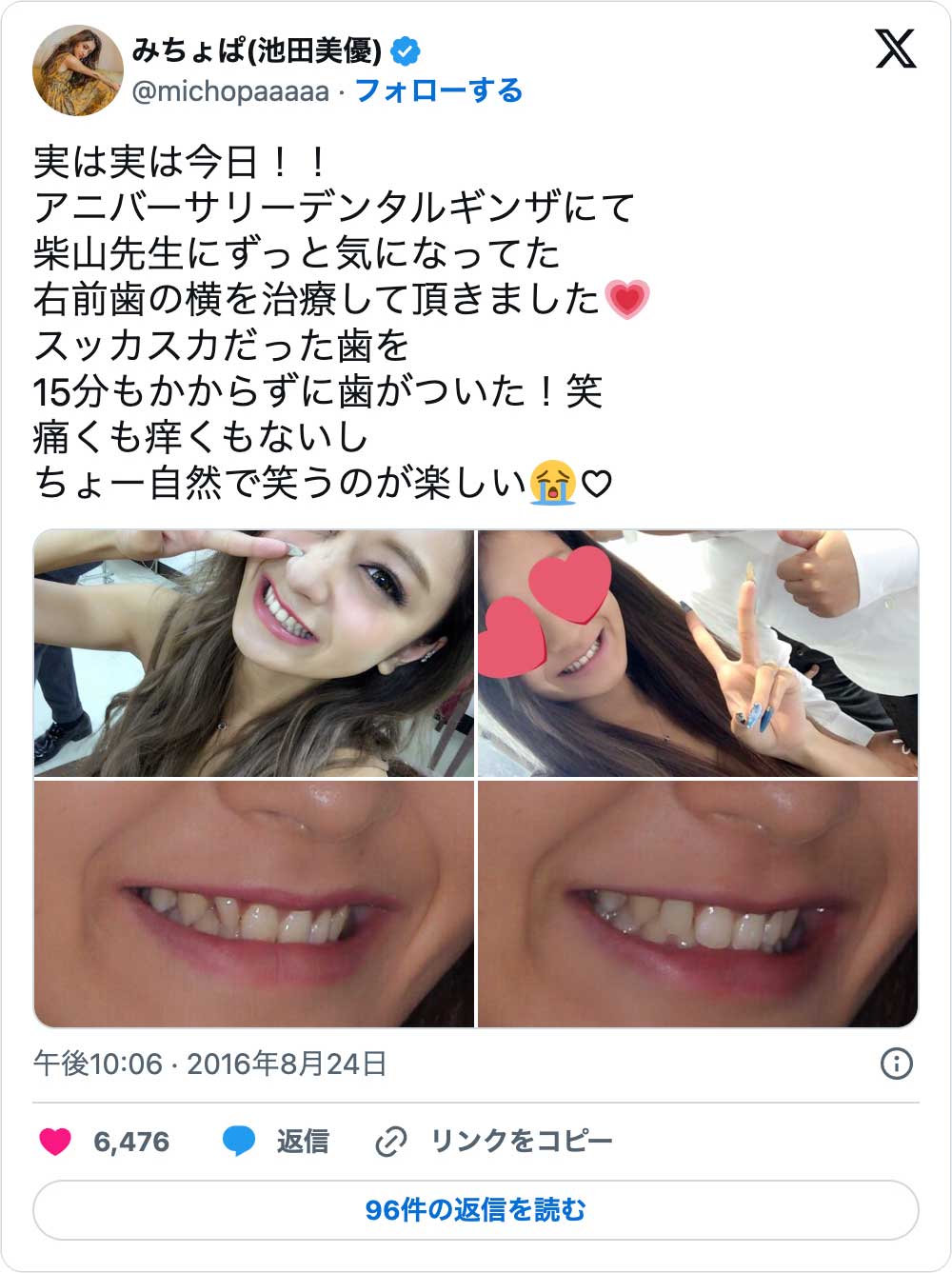 芸能人の歯はなぜ不自然に白い？セラミック矯正の裏側と後悔の真相