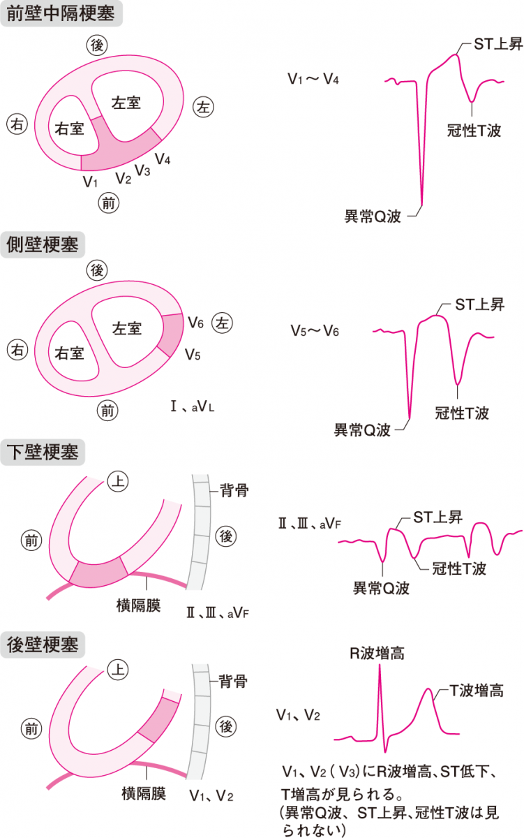 心筋梗塞の心電図変化と波形の特徴｜St上昇から異常Q波の真実