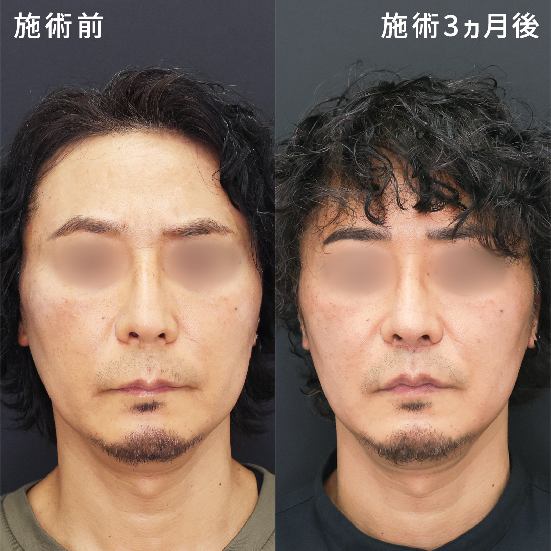 「鼻の下が長い男」の魅力とは？人相学とトレンドから紐解く秘密