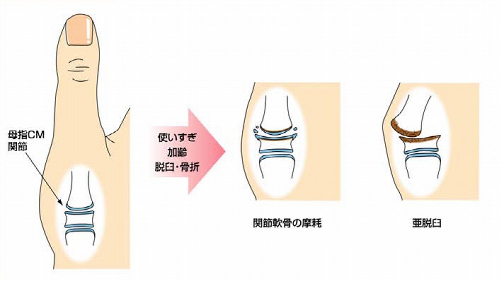親指の爪に黒い線が出たら危険？原因とメラノーマの見分け方を徹底解説