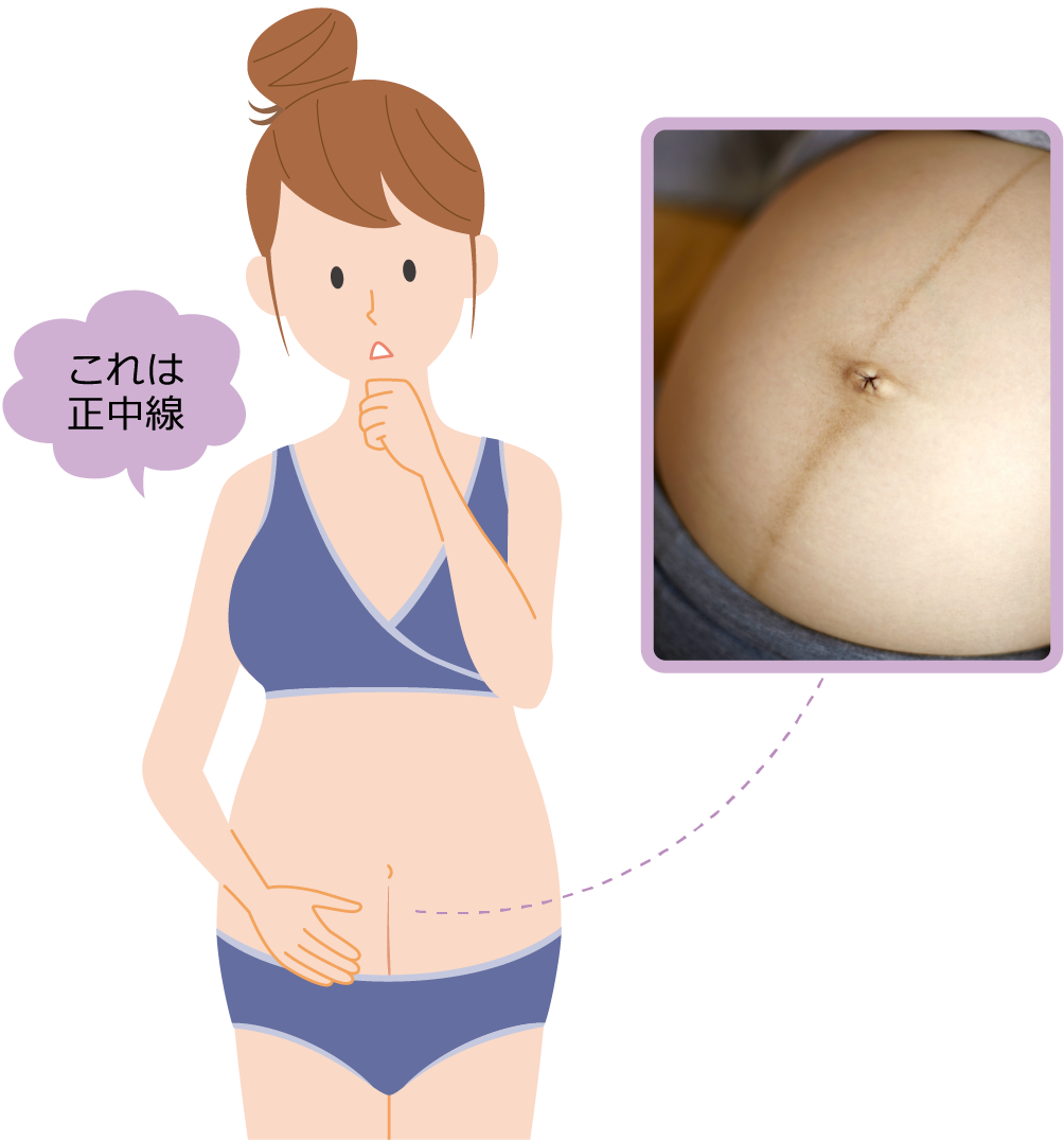 妊娠線とは？正中線との違いや予防ケア・消えない理由を徹底解説