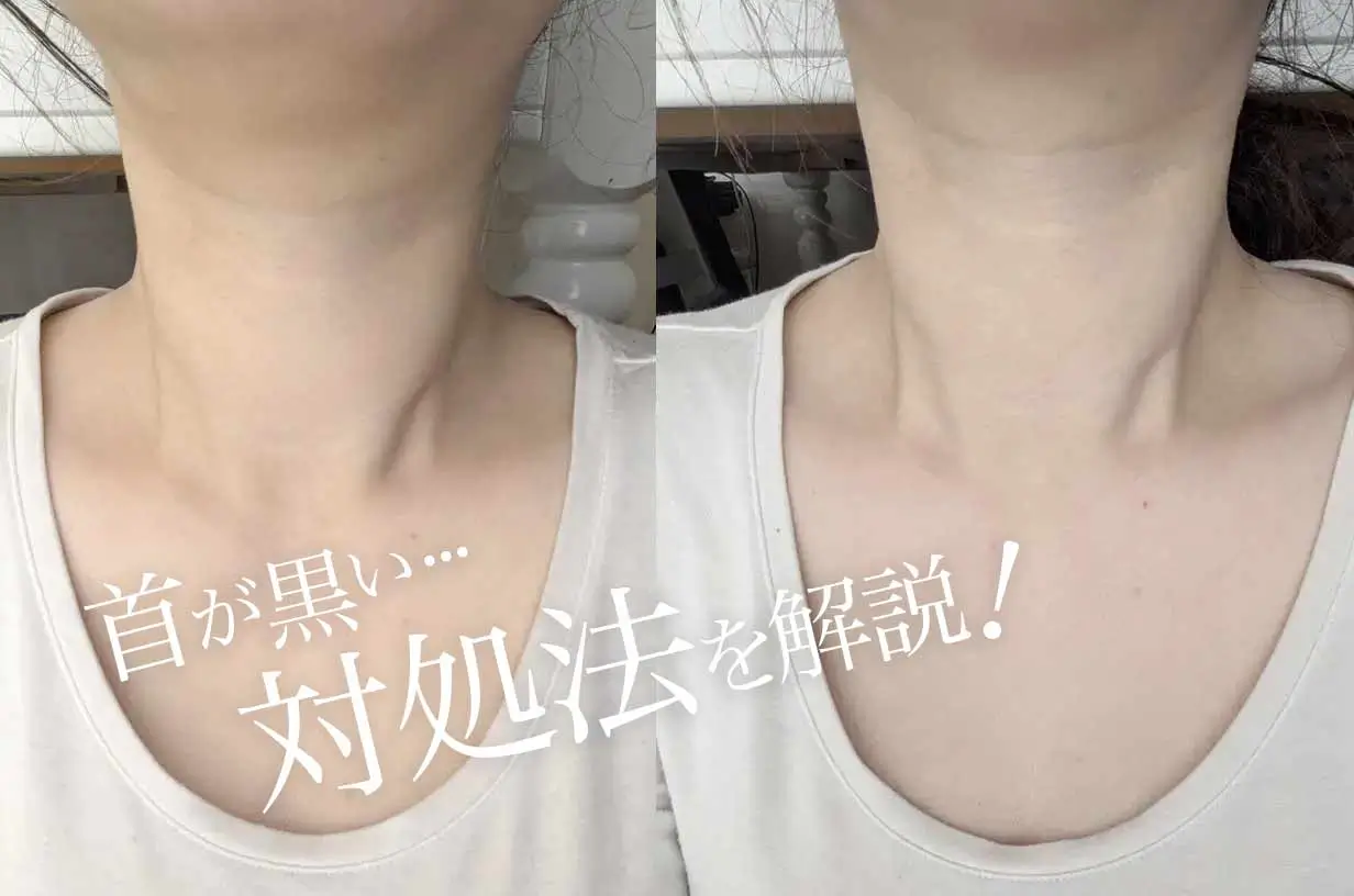 顔と首の色が違う決定的な原因とは？白浮き・日焼けを解消する美肌術