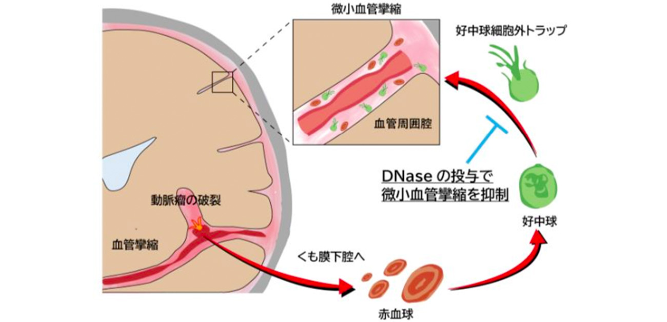 くも膜下出血後の危機「脳血管攣縮」とは？発症ピークと最新治療法