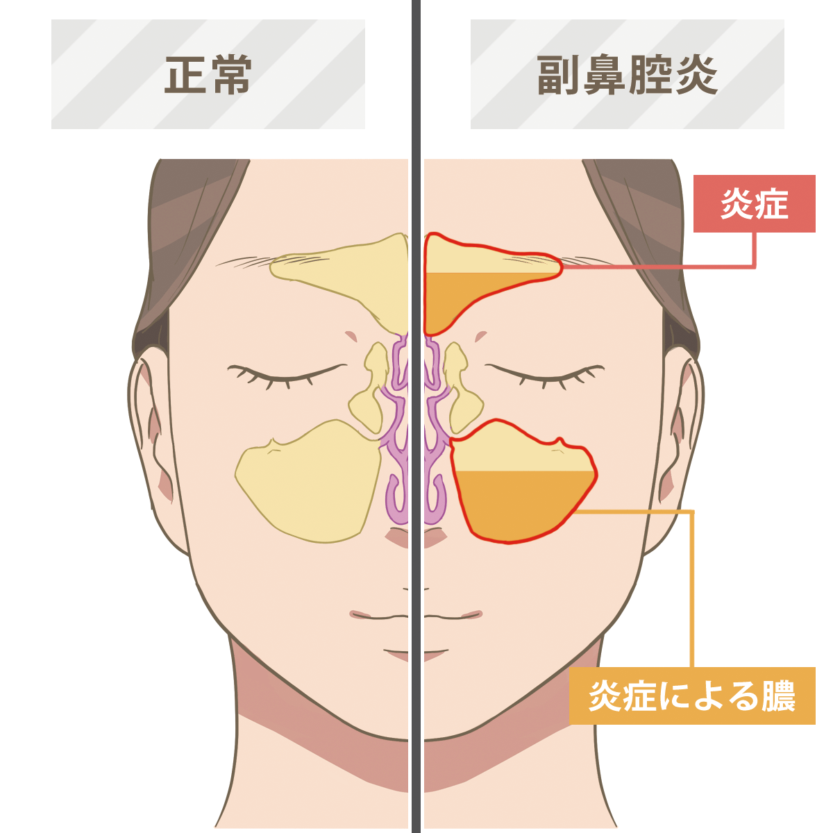 なぜ鼻水が黄緑色に？風邪放置で蓄膿症化するリスクと受診目安