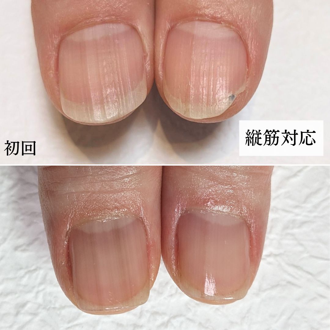 爪の縦線は病気？加齢と危険なサインの見分け方＆2026年最新ケア法