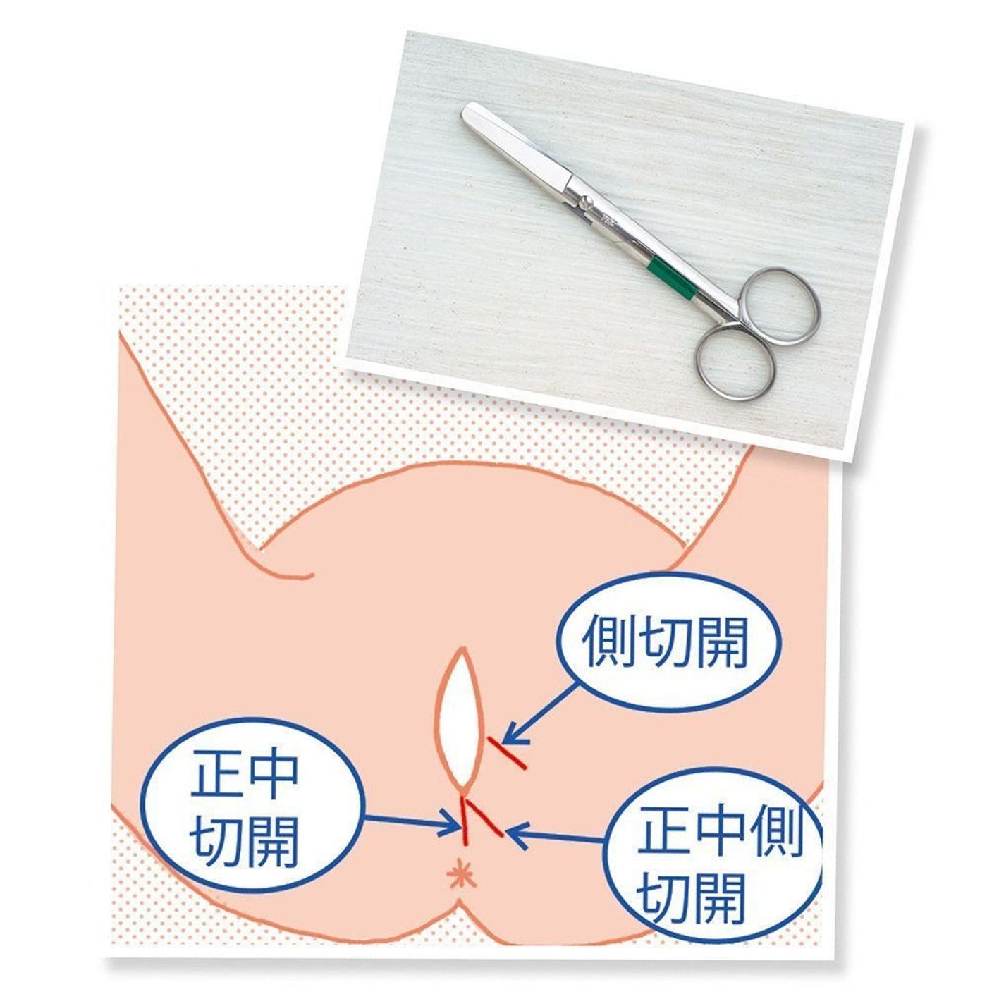 会陰切開の真実と回復の全記録｜なぜ切るのか・痛みの期間と対策