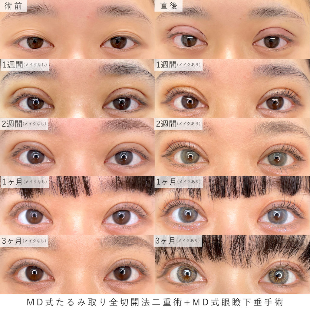まぶたの重みは病気のサイン？眼瞼下垂の10秒チェックと保険適用の基準