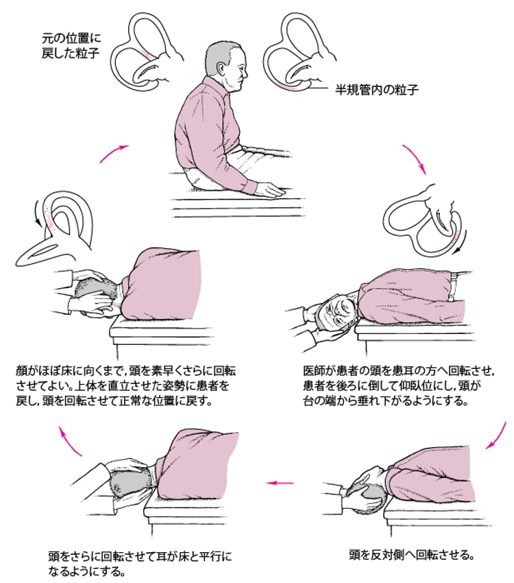 エプリー法の正しいやり方と悪化する理由｜左右の見分け方と安全手順