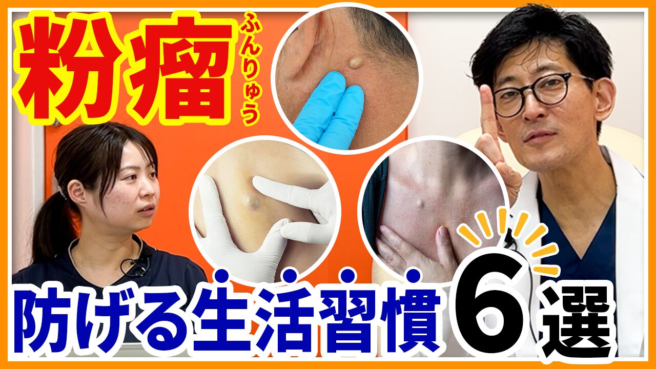 なぜ何度も再発？粉瘤ができやすい人の特徴と体質・根治を目指す最新治療