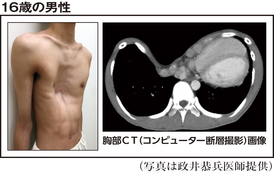 漏斗胸は筋トレで目立たなくできる？逆効果の真相と2026年の改善法