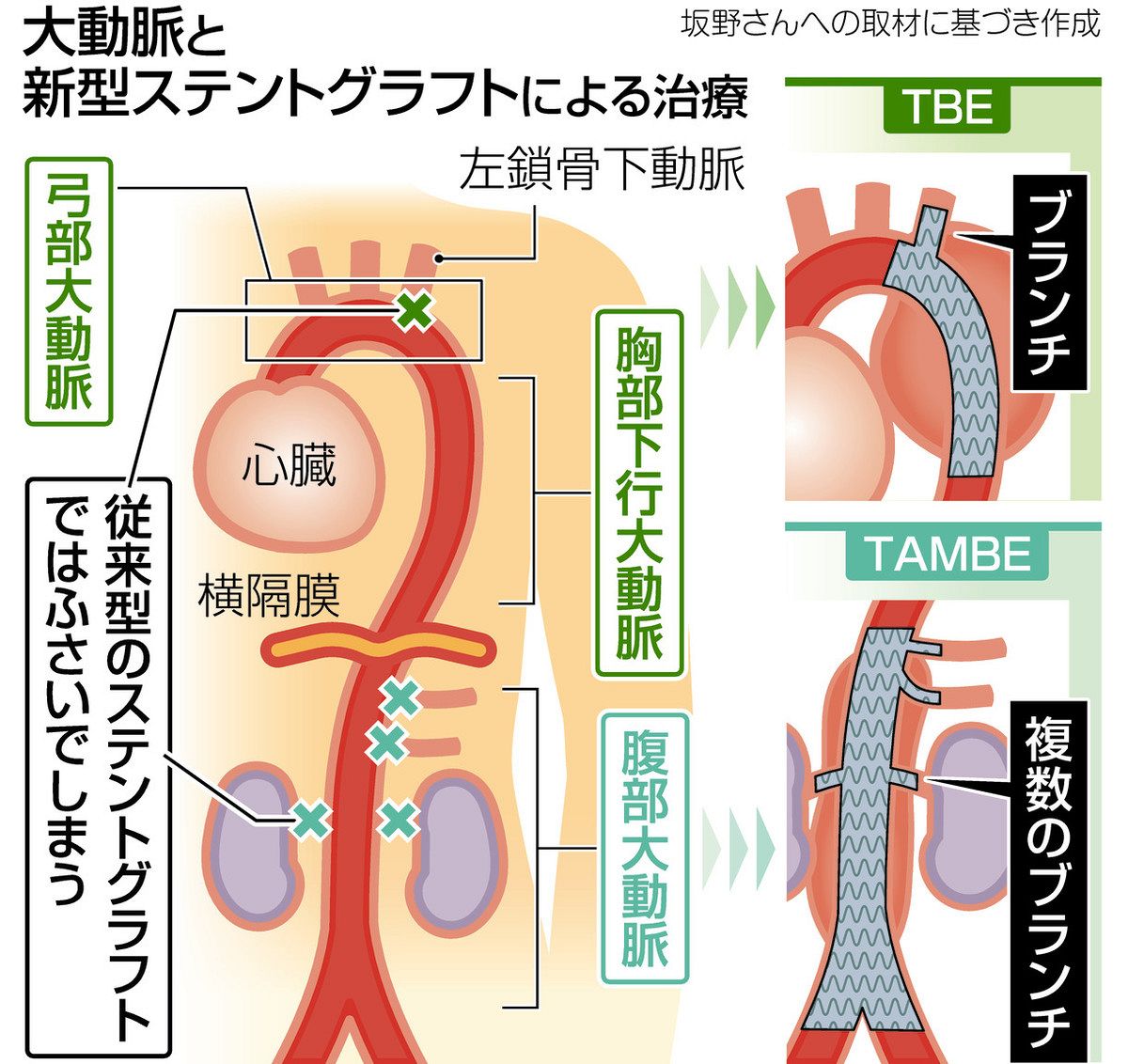 弓部大動脈瘤の破裂を防ぐ！声のかすれと2026年最新手術の全貌